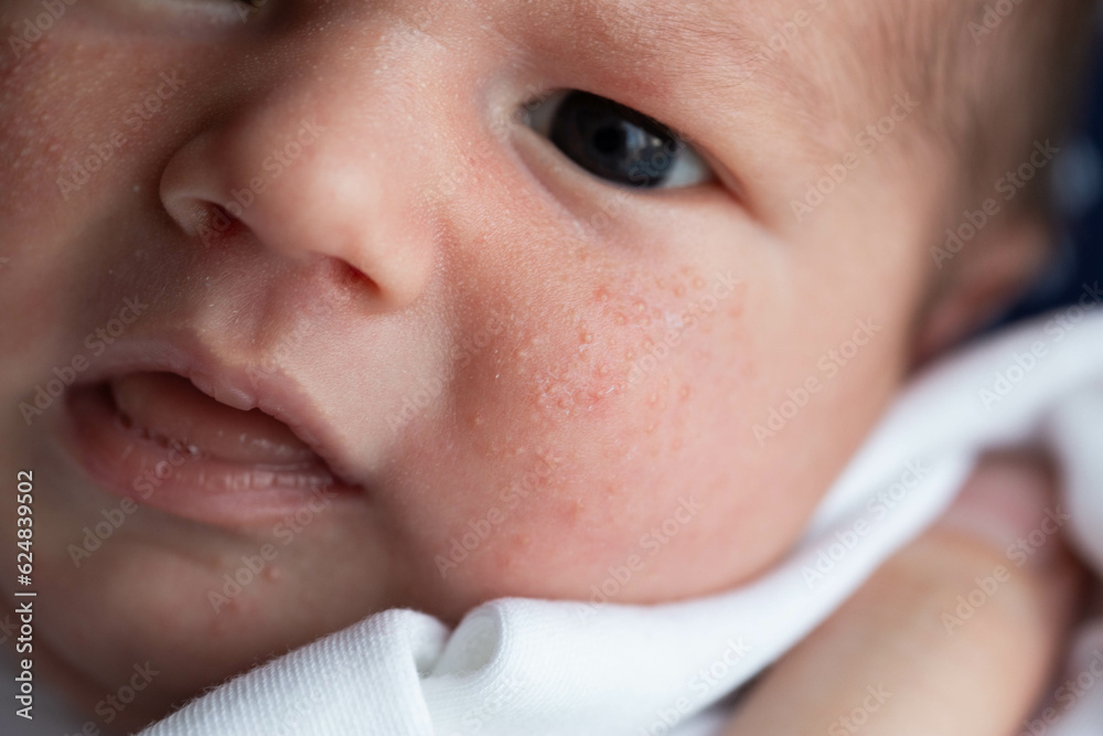 Allergic pimples in a newborn on the face. Pathogenesis, acne of