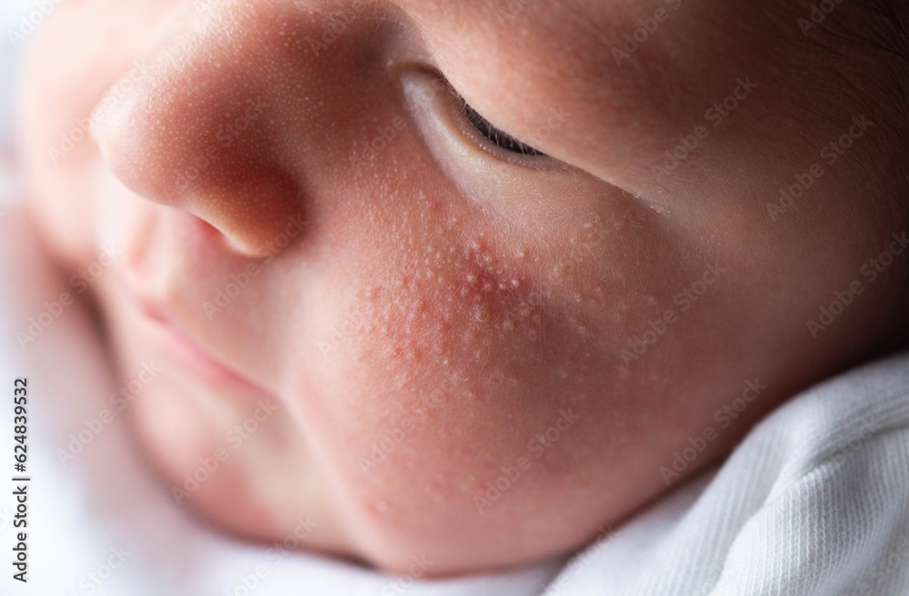 Allergic pimples in a newborn on the face. Pathogenesis, acne of