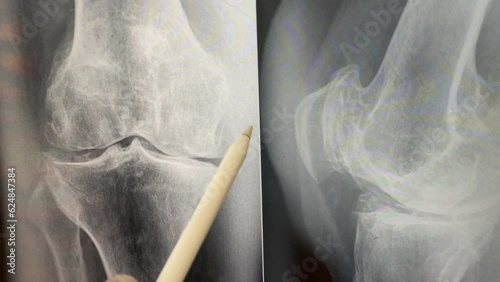 Plain X ray of the knee shows apparent joint osteoarthritis according to Kellgren and Lawrence system, subchondral sclerosis, knee joint inflammation