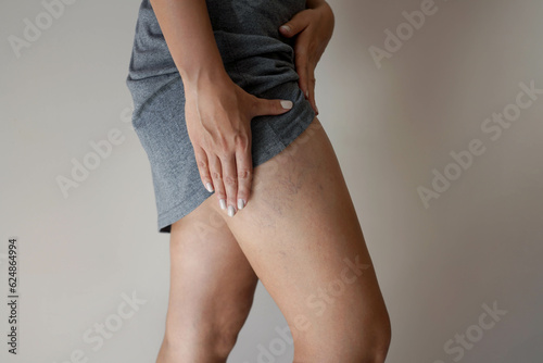 Painful varicose veins on woman legs photo