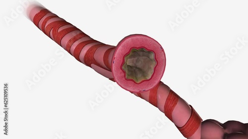 Bronchial asthma (or asthma) is a lung disease. Your airways get narrow and swollen and are blocked by excess mucus
