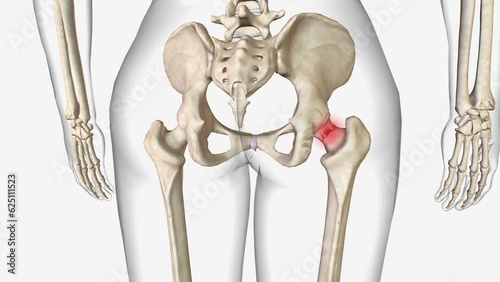 Femoral neck fractures are a specific type of intracapsular hip fracture photo