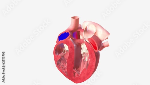 Atrial Septal Defect Blood Flow photo