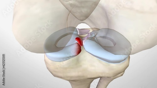 Meniscal root tears are less common than meniscal body tears and frequently go undetected photo