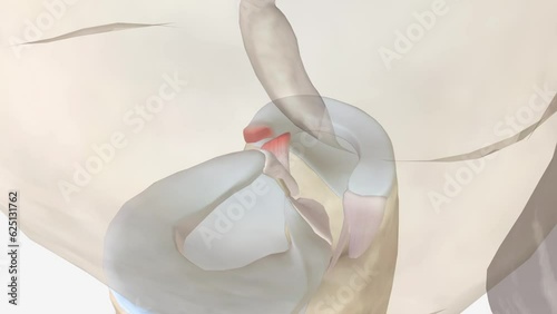 Meniscal root tears are less common than meniscal body tears and frequently go undetected photo