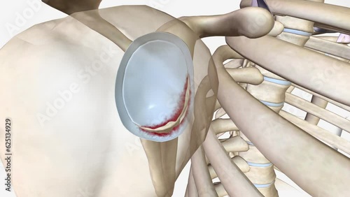 A Bankart lesion occurs as the result of a forward shoulder dislocation photo