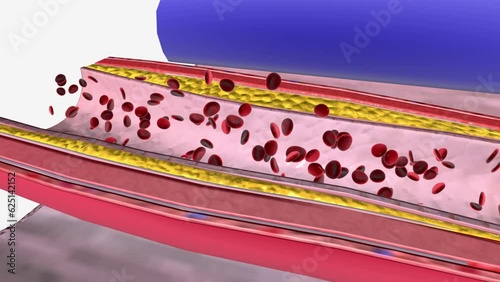 Atherosclerosis Progression in the Penis