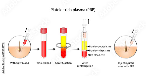 Platelet-rich plasma (prp). Autologous conditioned plasma, is a concentrate of PRP extracted from whole blood. After centrifugation, extract PRP and inject skin or hair. Vector Illustration. photo
