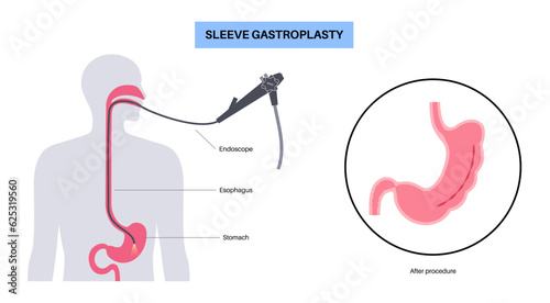 Endoscopic sleeve gastroplasty photo