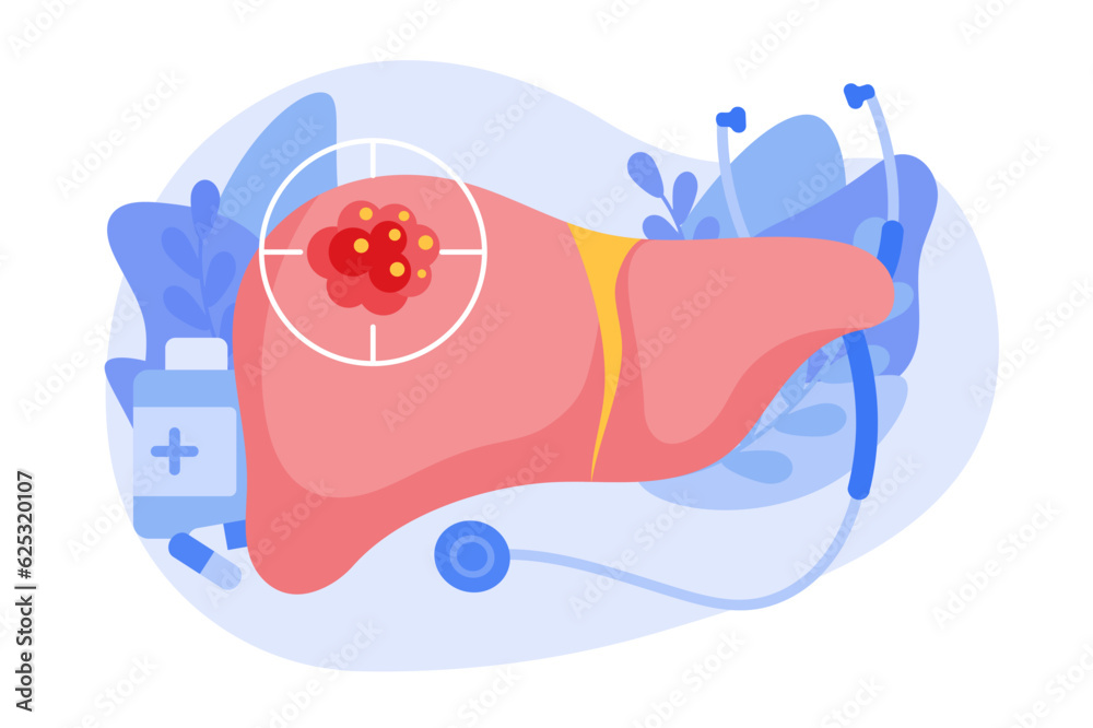 The concept of liver cancer. A malignant tumor develops in the liver. The structure of a cancer cell. flat vector illustration