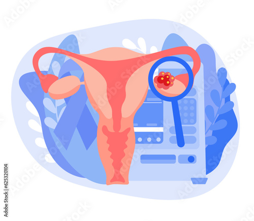 The concept of ovarian cancer. Disease of the female reproductive system. Abnormal internal organ of the uterus. Vector illustration