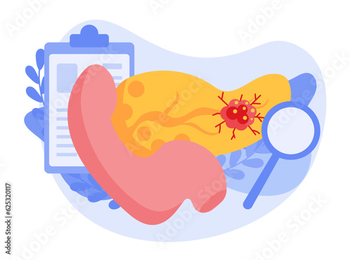 The concept of pancreatic cancer. There is a malignant tumor in the pancreas. The structure of a cancer cell. Flat vector illustration