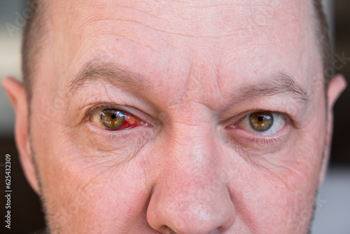 Blood in the eye of a broken blood vessels. Blood pressure. Injury. The eyeball injury from a blow. The adult man looking at the camera and rolling eyes. Impact of stress and fatigue on a human body