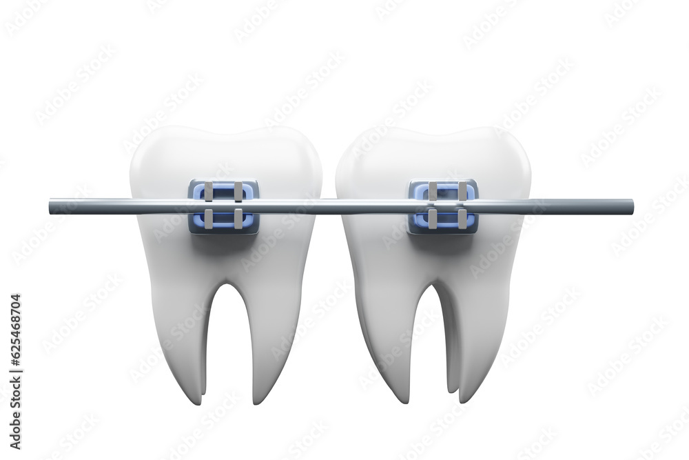 Teeth braces. Teeth alignment. teeth with braces . 3d render. Teeth braces. Teeth alignment. teeth with braces . 3d render.
