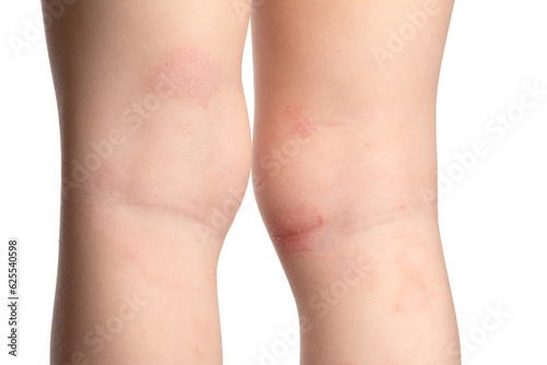 Fungal infection of the skin of the legs in a child. Defeat on the legs with a fungus, allergy close-up.
