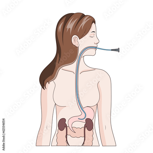 Nasogastric intubation diagram schematic vector illustration. Medical science educational illustration