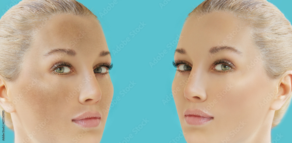 Dark spots, freckles,hyperpigmentation(melasma or chloasma),concept - skin lightening, skin whitening, fruit acids,AHA, Skin Brightening Dark spots, freckles,hyperpigmentation(melasma or chloasma),concept - skin lightening, skin whitening, fruit acids,AHA, Skin Brightening