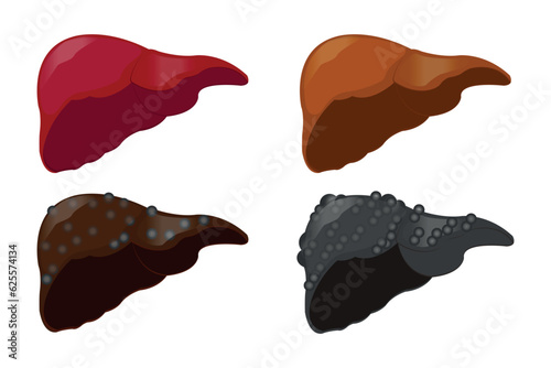 Stages of liver damage. Healthy, fatty, liver fibrosis and cirrhosis. isolated on white background. eps 10