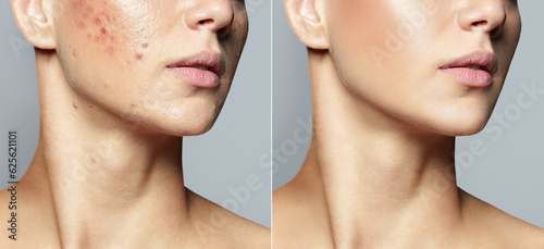 Teenage girl before and after acne treatment Skin care concept. Acne treatment in a cosmetology clinic
