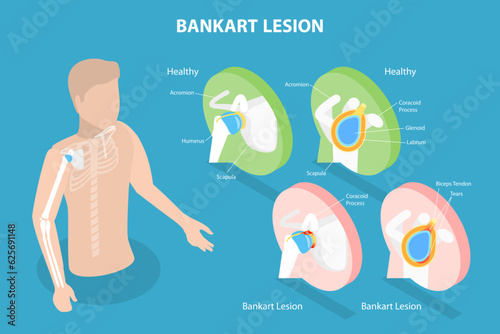 3D Isometric Flat Vector Conceptual Illustration of Bankart Lesion, Educational Diagram