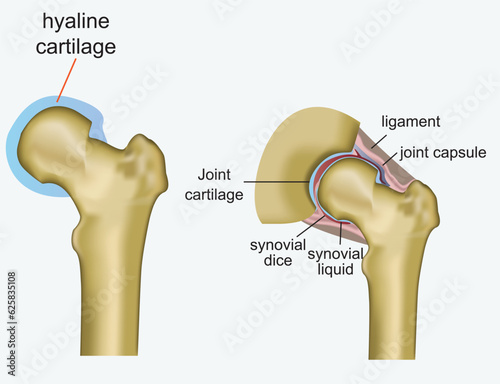 Stages of knee osteoarthritis. From Minimum disruption to lost a cartilage and joint-space reduction. Anatomy of knee joint. Vector illustration photo