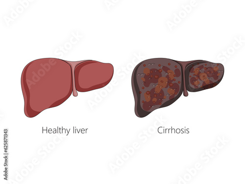 Healthy liver and liver with cirrhosis disease schematic vector illustration. Medical science educational illustration