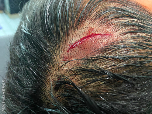 The lacerated wound as a result of impact with a sharp object