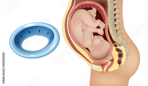 Cervical pessary in pregnant women with a short cervix. Modeling of effective positioning of Arabin cerclage pessary in women at high risk of preterm birth. Gynecological and obstetric pessary photo