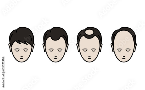 AGA、脱毛症が進行する男性のイラスト