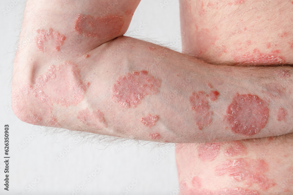 Papules of chronic psoriasis vulgaris on male hand and body on neutral background. Papules of chronic psoriasis vulgaris on male hand and body on neutral background.
