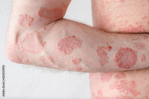 Papules of chronic psoriasis vulgaris on male hand and body on neutral background. photo