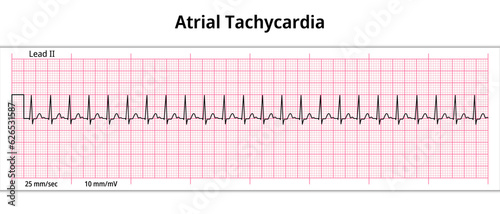 ECG Atrial Tachycardia - 8 Second ECG Paper - Electrocardiography Vector Medical Illustration

