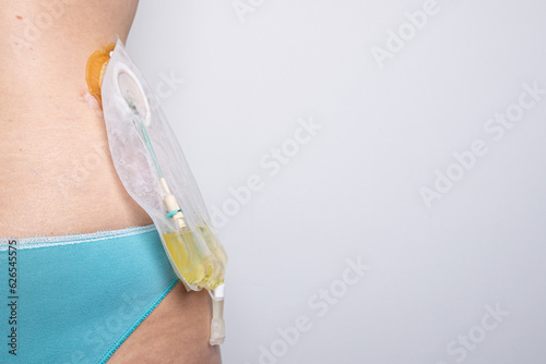 nephrostomy with a catheter tube between the kidney and a urine collection bag