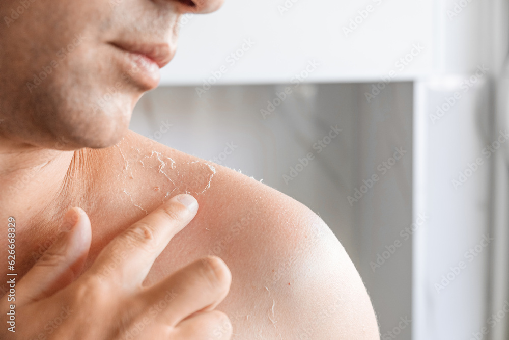 Sunburn on the skin. Exfoliation of the skin after sunburn. Man