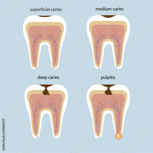 Set of teeth with stages of caries, tooth in section, tooth roots. Medicine, dental design, dental health. dental health concept. Deep, medium and initial caries, pulpitis. Dental health.