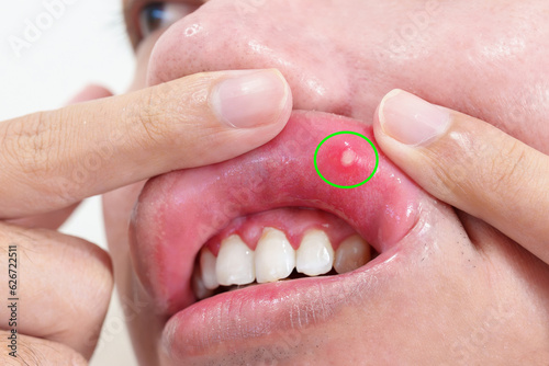 Mouth Ulcer Sore or Aphthous Stomatitis. Oral Health and Medical concepts photo