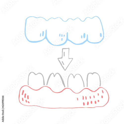 Orthodontic silicone trainer. Invisible braces retainer. Vector illustration