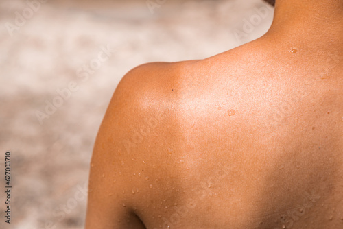 Wallpaper Mural  Woman shoulder with skin burn of photosensitivity. Summer sunbathing danger. Sun danger. Tanned shoulder. Copy space.
 Torontodigital.ca