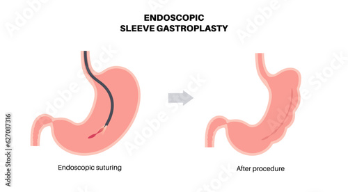 Endoscopic sleeve gastroplasty
