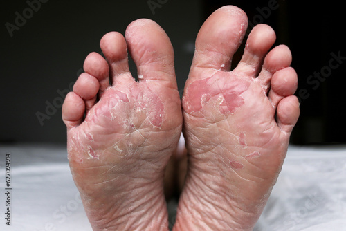 Close up of dry feet. Peeling and cracked foot. Fungal infection or athlete's foot, dry skin, dermatitis, eczema, psoriasis, sweaty feet or dehydration. Health care concept.
