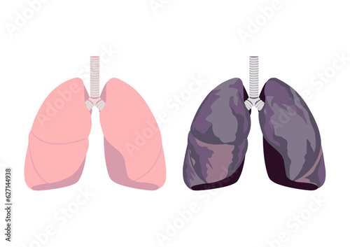 健康な肺と喫煙者の肺 © 楠　英浩
