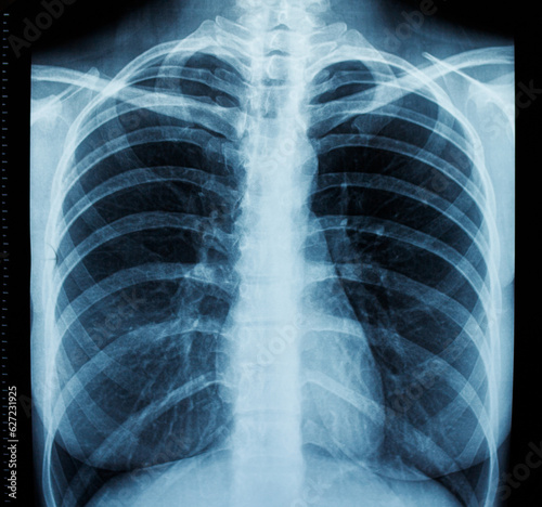 Fluorography of the human chest, frontal x-ray.