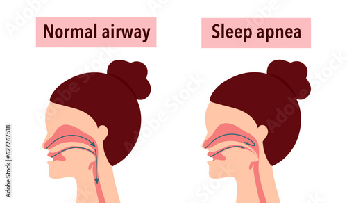 Obstructive sleep apnea syndrome concept vector illustration.
