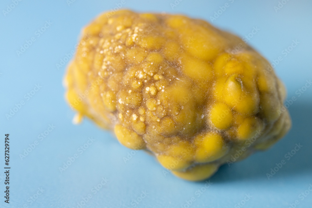 Gallstones,multiple cholesterol stone in gallbladder with cholecystitis
