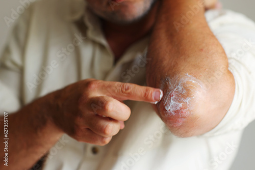 applying an cream emollient to dry flaky skin as in the treatment of psoriasis, eczema and other dry skin conditions photo