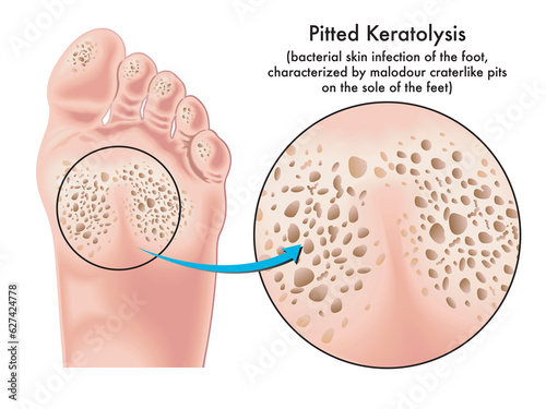 Medical illustration of symptoms of pitted keratolysis, a bacterial skin infection of the foot. photo