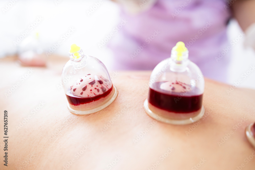 Close up view of hijama therapy cups filled with blood as part of alternative medicine. Close up view of hijama therapy cups filled with blood as part of alternative medicine.