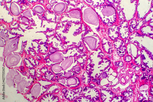 Obraz na płótnie Micrograph of prostatic hyperplasia