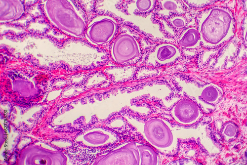 Cuadro en lienzo Micrograph of prostatic hyperplasia