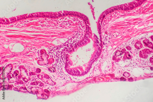 Photomicrograph of bronchial epithelial squamous metaplasia photo